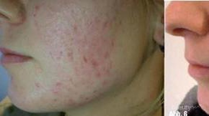 [FORUM] Dermal Punch Prp, Treatment Kecantikan untuk menghilangkan jerawat & Mengecilkan Pori-pori-pori