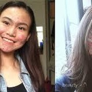 [FORUM] Argghhhh mau menikah, tapi jerawatku malah meradang! Solusi please dear...