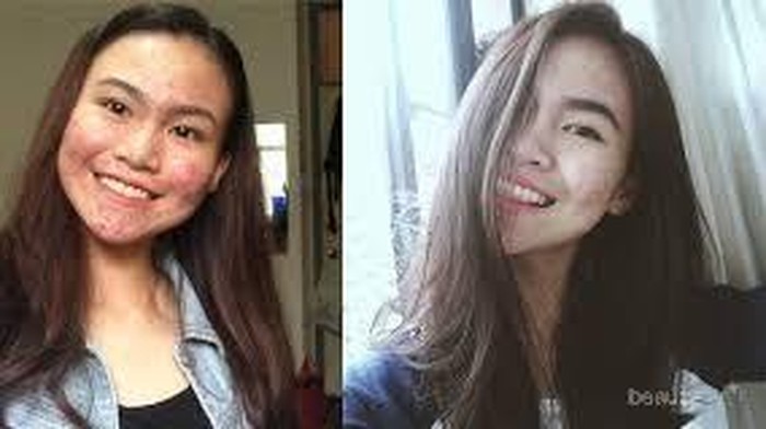 [FORUM] Argghhhh mau menikah, tapi jerawatku malah meradang! Solusi please dear...