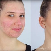 Jerawat di Wajah Tertutupi Sempurna dan Hasilnya Super Flawless Hanya dengan Cara Ini Saja