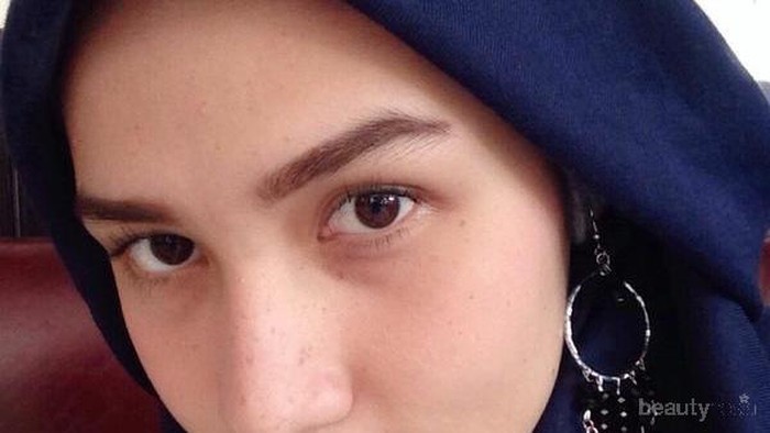 Bener enggak sih Caladine bisa ngilangin bekas jerawat? Bener enggak sih Caladine bisa ngilangin bekas jerawat?