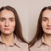 Ladies, Jangan Sampai Salah! Ini Tips Make Up yang Tepat dan Flawless untuk Kulit Berjerawat