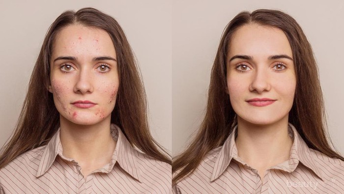 Ladies, Jangan Sampai Salah! Ini Tips Make Up yang Tepat dan Flawless untuk Kulit Berjerawat