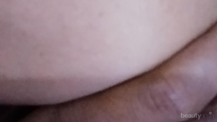 [FORUM] Apakah ada yang jerawatan setelah memakai sunblok?