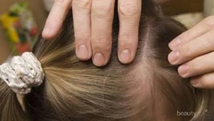 [FORUM] Dear gimana atasin rambut berkutu?