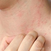 [FORUM] Masih ada yang suka mengalami biang keringat tiba-tiba?