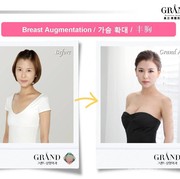 #FORUM Perlukah Silikon Payudara Diganti Berkala?