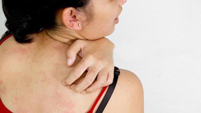 [FORUM] Ada yang tau ga, apa obat buat alergi ayam dan seafood?