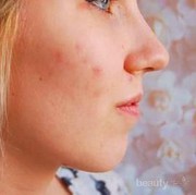 #FORUM gimana cara hilangin flek hitam bekas jerawat girls dan bekas lobangnya