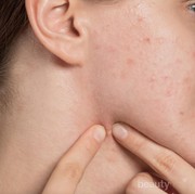 #FORUM Problem Jerawat! 5 Tahun Berjuang Melawan Jerawat di Wajah