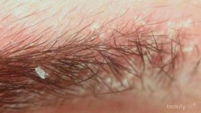 [FORUM] Lho, Ketombe Muncul di Alis, Gimana Ngilanginnya?