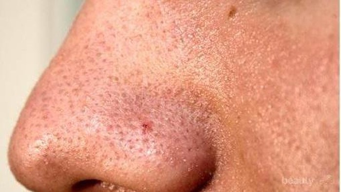 [FORUM] Duh! Komedo ku kok Nggak Hilang-hilang ya?