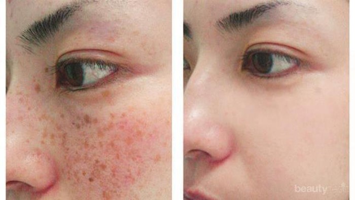 [FORUM] Pakai Perawatan Dokter Beneran Bikin Kulit Mulus Tanpa Pori-pori?