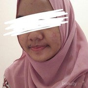 [FORUM] Saran dong dear, bagaimana hilangkan bekas jerawat & merawat kulit berminyak