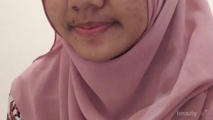 [FORUM] Saran dong dear, bagaimana hilangkan bekas jerawat & merawat kulit berminyak