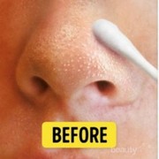 [FORUM] Ada saran untuk menghilangkan komedo yang paling ampuh?