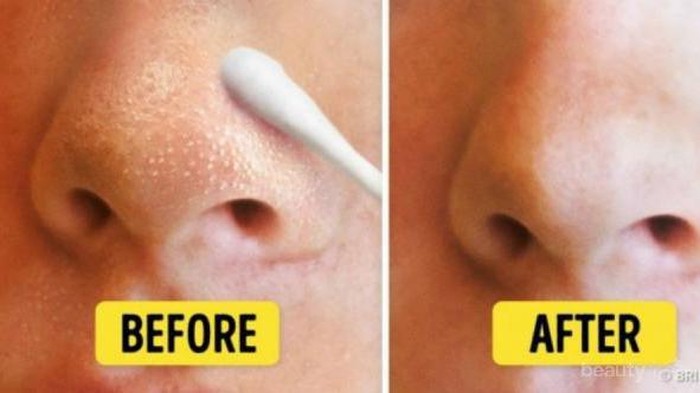 [FORUM] Ada saran untuk menghilangkan komedo yang paling ampuh?