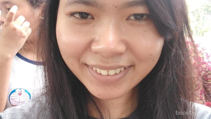 [FORUM] Cara Hilangin jerawat dan bekasnya Jerawat