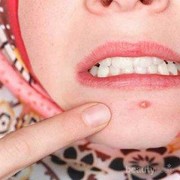 [FORUM] Gimana sih menghilangkan jerawat yang mirip bisul?