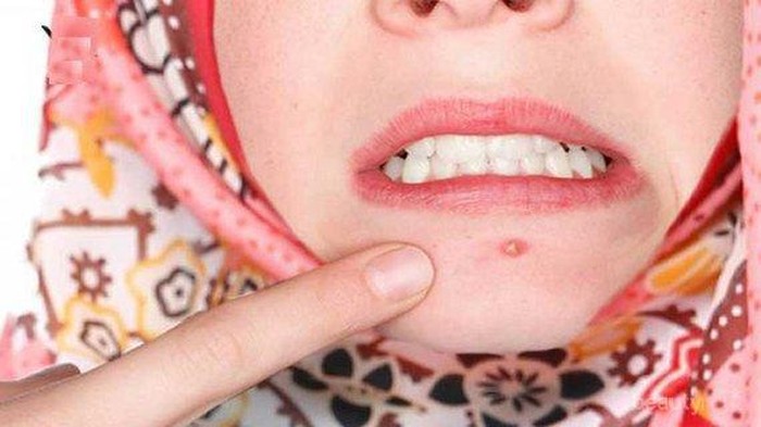 [FORUM] Gimana sih menghilangkan jerawat yang mirip bisul?