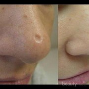 [FORUM] Info dong! Obat ampuh penghilang bekas cacar beserta bopengnya