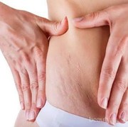 [FORUM] Sharing info menghilangkan stretchmark yuk ladies!