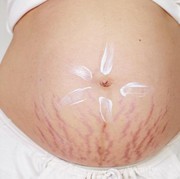 [FORUM] Stretchmarks Bisa Hilang Ga Sih ???