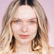 [FORUM] Bolehkah Wajah Jerawatan Melakukan Peeling?