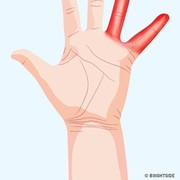 [FORUM] Kesemutan hanya pada jari manis dan kelingking, apa penyebabnya?