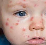 [FORUM] Sharing Cara yang ampuh hilangkan bekas cacar, Ladies Help Me!