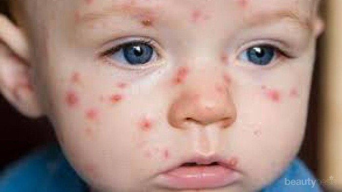 [FORUM] Sharing Cara yang ampuh hilangkan bekas cacar, Ladies Help Me!