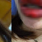 [FORUM] Gara-gara Lipstik Palsu, Bibir Wanita Ini Mengalami Infeksi! Hati-hati Ladies