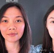 [FORUM] Suntik putih untuk memutihkan kulit instan apakah berbahaya?