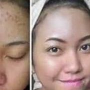 [FORUM] Produk apa yang bisa menghilangkan bekas jerawat untuk kulit sensitif?