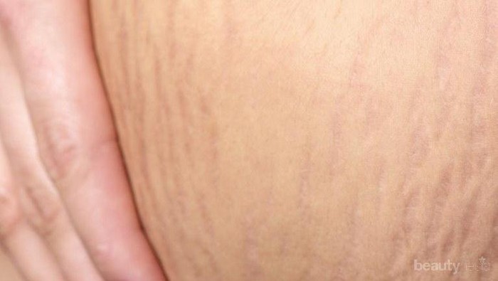 [FORUM] Produk yg Bisa menyamarkan Stretch Marks