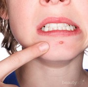 Gimana sih cara hilangkan jerawat membandel