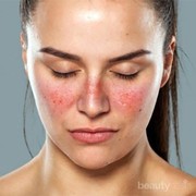 [FORUM] Kulit wajah ruam merah gara-gara gak cocok pakai skincare, pernah?