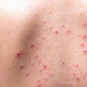 [FORUM] Gimana sih Cara menghilangkan Jerawat Punggung yg membandel dan membekas? Bagi tips nya dong Sis ! :(