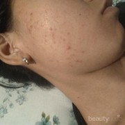 [FORUM] Sabun Muka Yang Cocok untuk kulit berminyak dan berjerawat