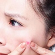 #FORUM Ladies, Pencet Jerawat Nggak Berbahaya Sama Sekali!