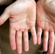 [FORUM] Telapak tangan aku super kering banget, gimana cara mengatasinya ya?