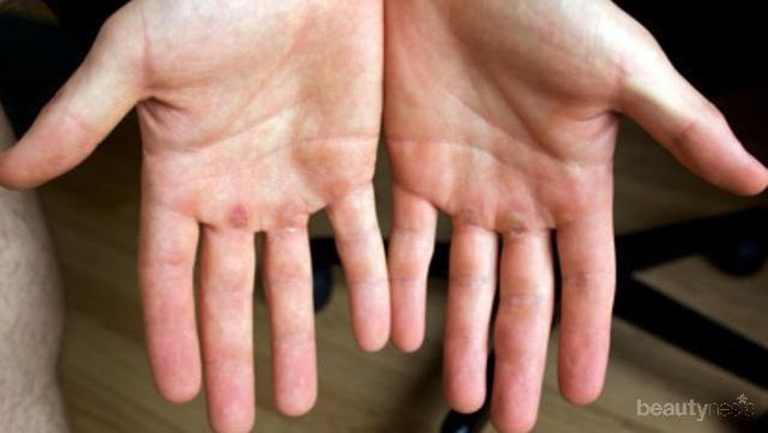 [FORUM] Telapak tangan aku super kering banget, gimana cara mengatasinya ya?