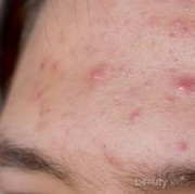 #FORUM lepas dari produk dokter muka jadi berjerawat  dan beruntusan di dahi dan di pipi