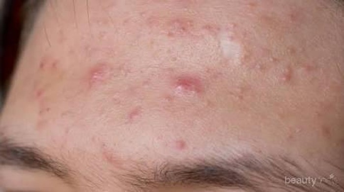 #FORUM lepas dari produk dokter muka jadi berjerawat  dan beruntusan di dahi dan di pipi