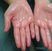 [FORUM] Telapak tangan gampang basah, sebenarnya berbahayakah?