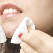 [FORUM] Jerawat Aku Selalu Muncul di Tempat yang Sama, Ngilanginnya Gimana?