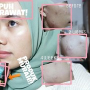 [FORUM] Produk lokal apa yang bisa nyembuhin jerawat