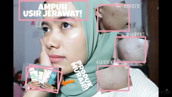 [FORUM] Produk lokal apa yang bisa nyembuhin jerawat