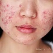 [FORUM] Hilangkan Jerawat Perawatan di Dr Kun Jayanata