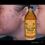 [FORUM] Merek Cuka Apel Apasih yang Cocok Ngilangin Jerawat?